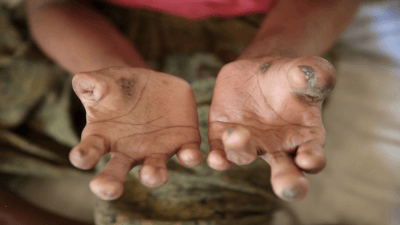 WHO Global Leprosy Strategy 2021-2030