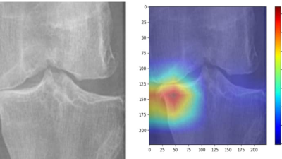 AI Model for Knee Osteoarthritis Detection
