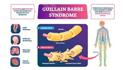 Guillain-Barré Syndrome Cases