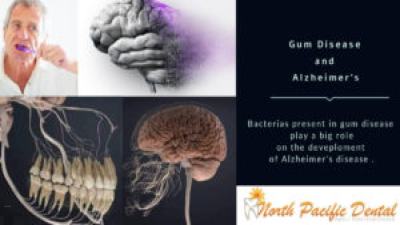 Gum Disease and Alzheimer’s