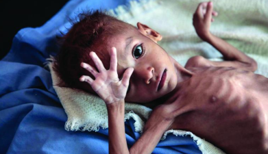 Protocol to manage Malnourishment released