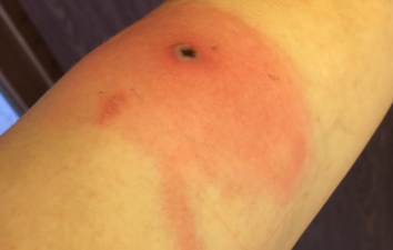Alaska’s Fatal New Orthopox Virus
