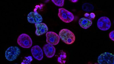 Study Reveals How Ovarian Cancer Cells Migrate