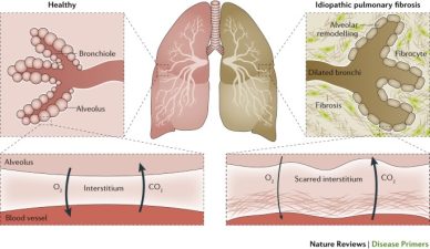 About Idiopathic Pulmonary Fibrosis and Its Impact