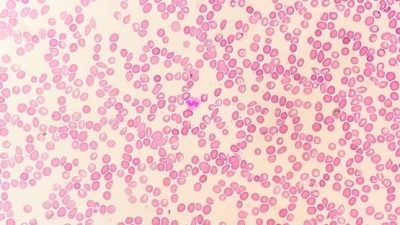 AnemiaPhone Revolutionises Iron Deficiency Diagnosis in India