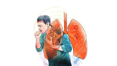 100-Day TB Elimination Campaign