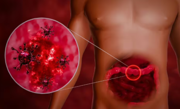 Norovirus Surge Prompts Urgent Public Health Warnings