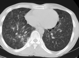 A Breakthrough in Silicosis Detection