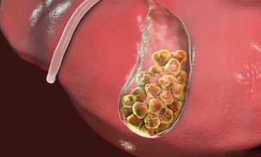 Gallbladder Cancer Linked to Toxic Metals in Assam