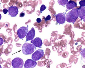 Rapid Diagnosis of Acute Promyelocytic Leukaemia