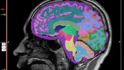 Shingles Vaccine’s Impact on Dementia Risk