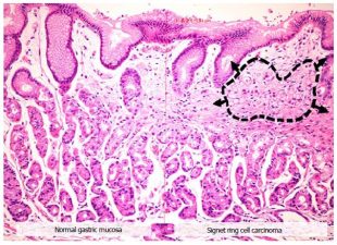 Signet Ring Cell Carcinoma Treatment Breakthrough