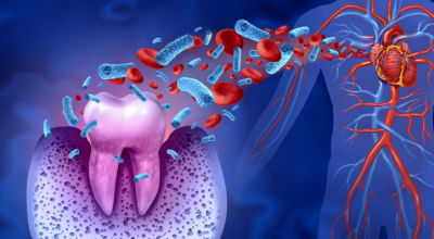Oral Bacteria Linked to Heart Attack Risk