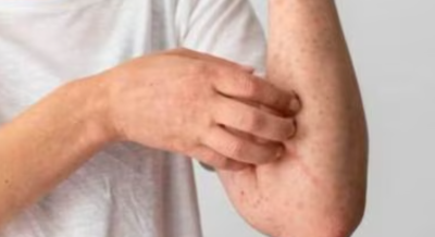 Fungal Disease Research and Diagnostics in India