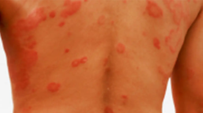 AI Diagnosis Autoimmune Blistering Diseases